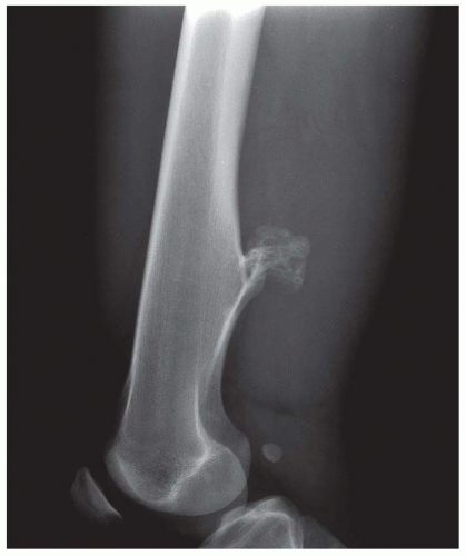 Osteochondroma (Osteocartilaginous Exostosis) | Musculoskeletal Key