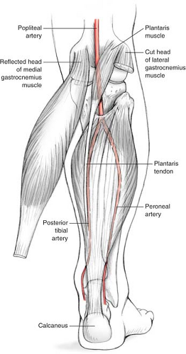 The Pedicled Soleus Muscle Flap for Coverage of the Middle and Distal