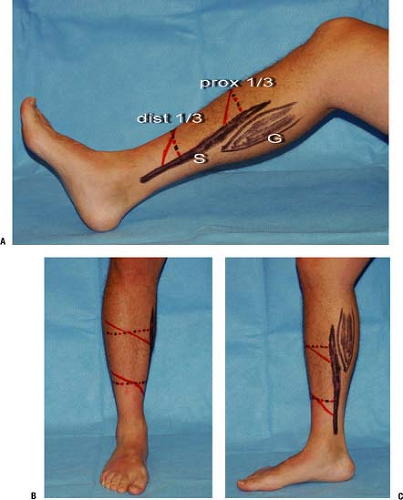 The Pedicled Soleus Muscle Flap for Coverage of the Middle and Distal