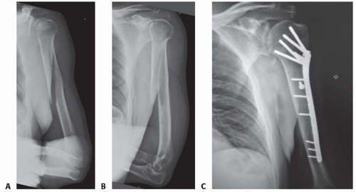 Plate Fixation Of Humeral Shaft Fractures Musculoskeletal Key