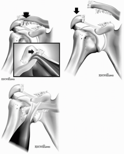 Acromioclavicular Joint Difficult Problems And Revision Surgery