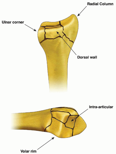 Fragment-Specific Fixation of Distal Radius Fractures | Musculoskeletal Key