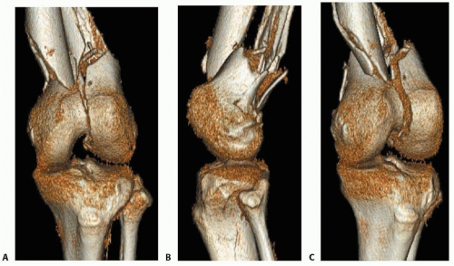 Open Reduction and Internal Fixation of the Distal Femur ...