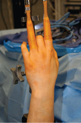 Wrist Arthroscopy Basics: Anatomy, Portals, and Diagnostic Arthroscopy
