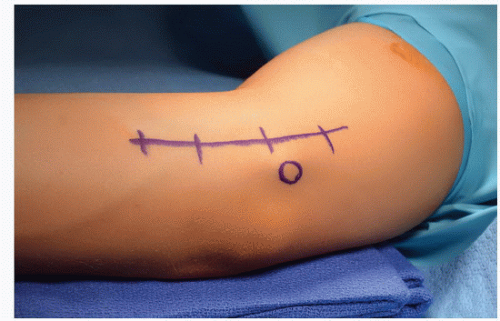 Ulnar Collateral Ligament Reconstruction Of The Elbow Musculoskeletal Key