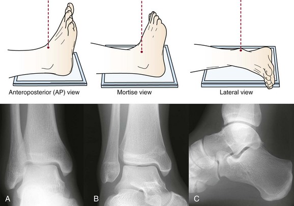 Imaging Of The Foot And Ankle Musculoskeletal Key