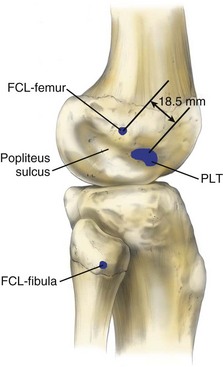 Fibular Collateral Ligament And The Posterolateral Corner