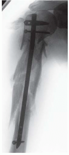 Humeral Shaft Fractures Intramedullary Nailing Musculoskeletal Key