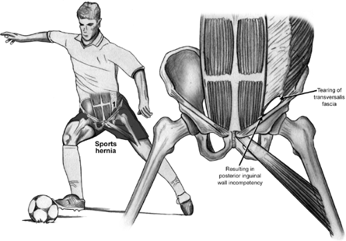 Occult Groin Injuries: Athletic Pubalgia, Sports Hernia, and Osteitis