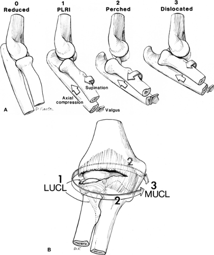 Lateral Ulnar Collateral Ligament Reconstruction Musculoskeletal Key