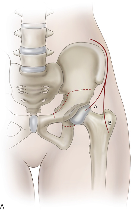 What is a periacetabular osteotomy?