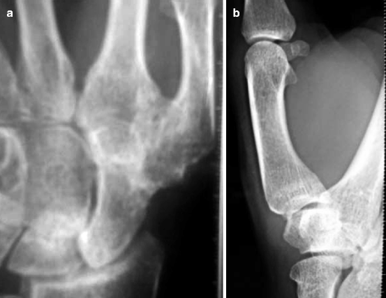 icd 10 right hip sprain strain