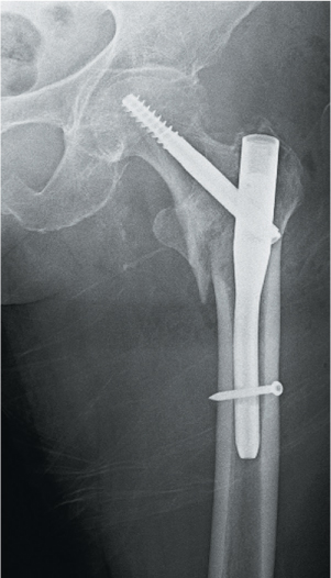 Extracapsular proximal femur fractures | Musculoskeletal Key