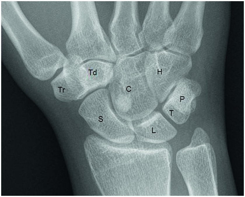 Pediatric Colles Fracture, Pediatric Radiology Reference Article, Pediatric Imaging