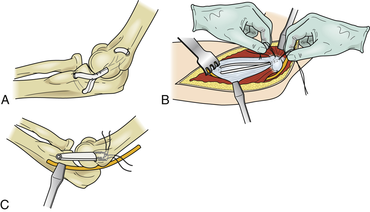 Ulnar Collateral Ligament Reconstruction Musculoskeletal Key