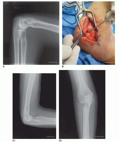 A case of bilateral elbow dislocation in a patient with Rubinstein