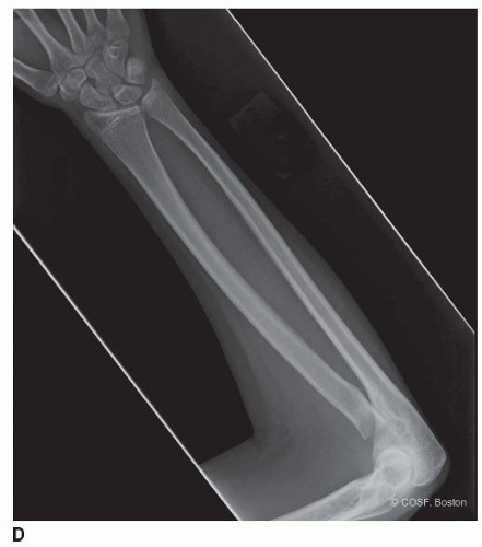 Congenital Radial Head Dislocation | Musculoskeletal Key