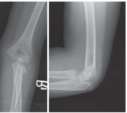 non displaced radial head fracture