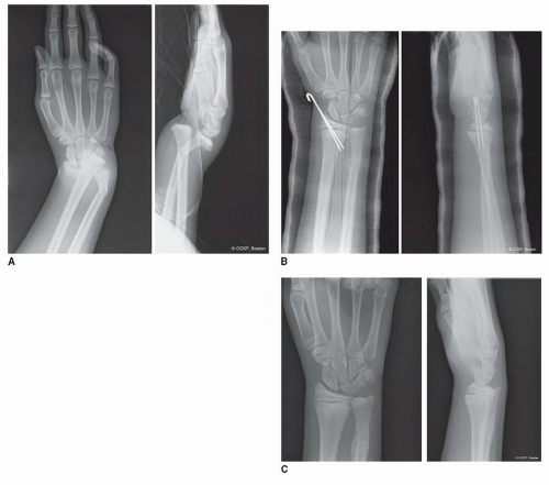 icd 10 code for right ulnar styloid fracture