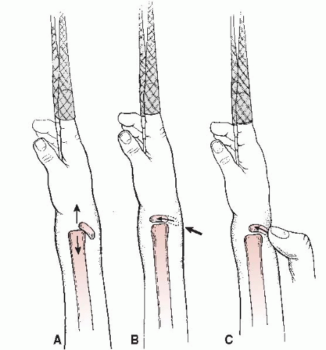 Distal Radius and Carpal Fractures | Musculoskeletal Key