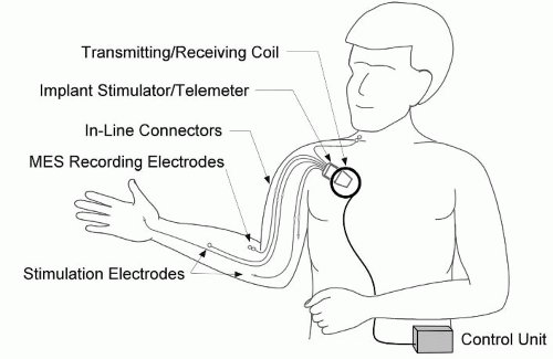 Robotic and neuromuscular electrical stimulation (NMES) hybrid system -  ScienceDirect