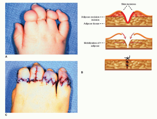 amniotic band syndrome toes