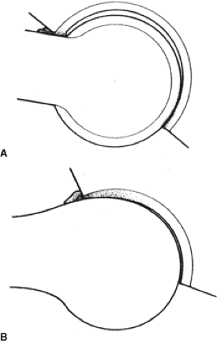 Biomechanics Of The Natural Hip Joint | Musculoskeletal Key