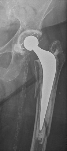Periprosthetic Fractures Of The Femur Associated With Hip Arthroplasty