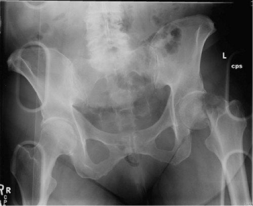 Heterotopic Bone Formation | Musculoskeletal Key