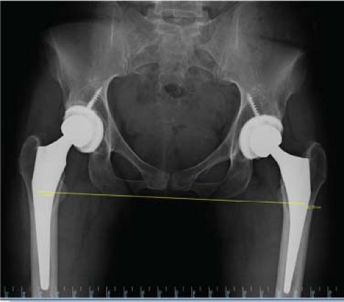 Posterior total hip replacement surgery video