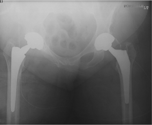 The Direct Anterior Approach To Revision Total Hip Arthroplasty ...