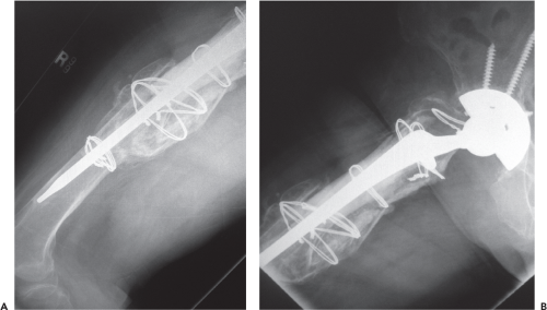 Allograft Prosthetic Composites For Femoral Revision | Musculoskeletal Key