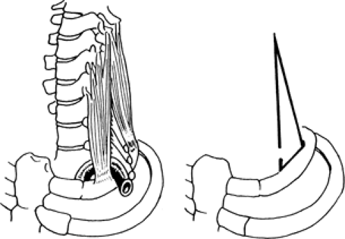 neurological thoracic outlet syndrome