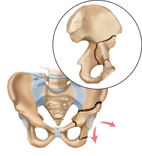 Periacetabular Osteotomy for the Treatment of Symptomatic Acetabular ...