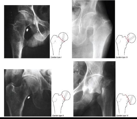 normal hip xray femoral neck fracture xray