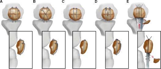 Extensor Mechanism Injuries Of The Knee Musculoskeletal Key