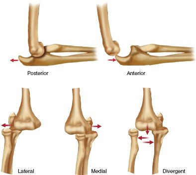 elbow dislocation classification