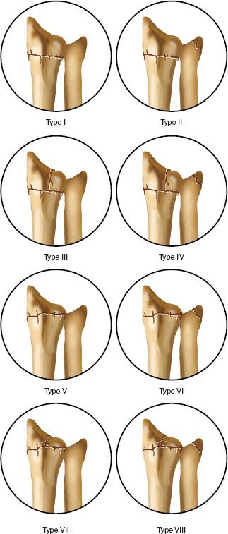 colles fracture classification