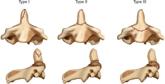 type 3 odontoid fracture