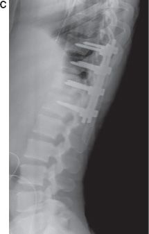 Thoracolumbar Spine Fractures And Dislocations Musculoskeletal Key