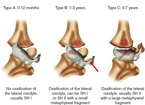 humerus distal fractures pediatric classification delee extremity injuries upper figure lateral