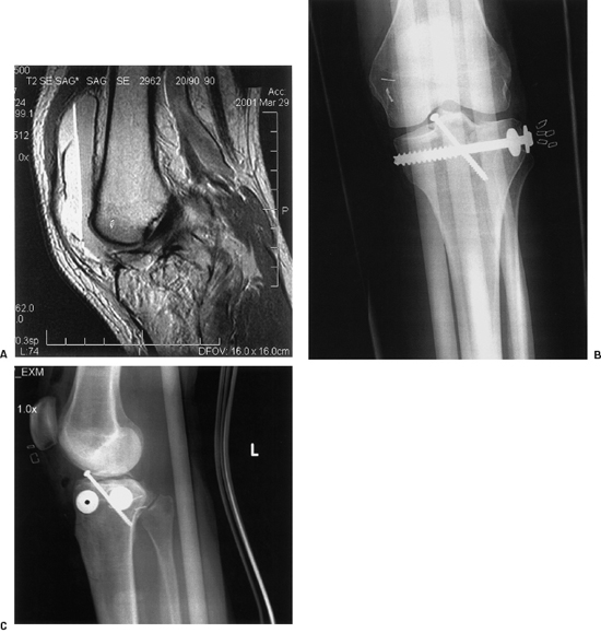 Tibial Spine Fractures  Florida Orthopaedic Institute