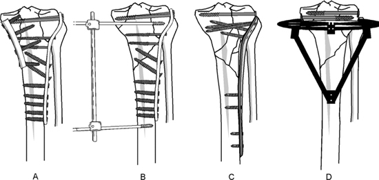 Tibial Plateau Combined Fractures Musculoskeletal Key