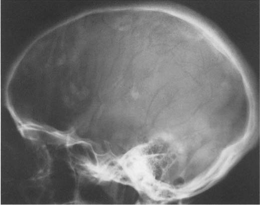 skull fracture calcification