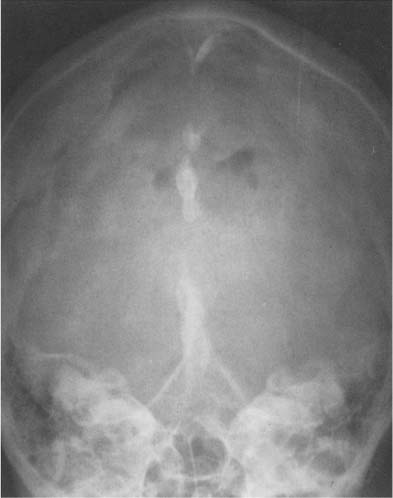 skull fracture calcification