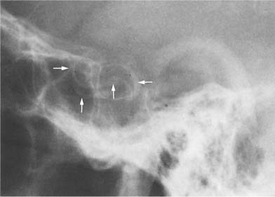 skull fracture calcification