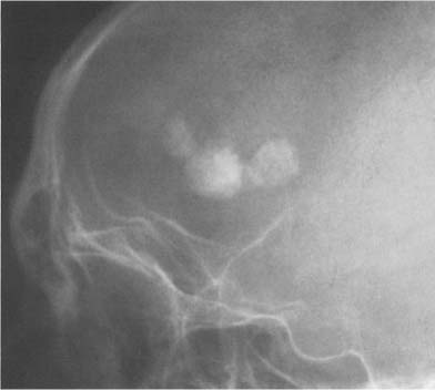 skull fracture calcification