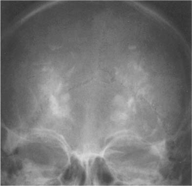 skull fracture calcification