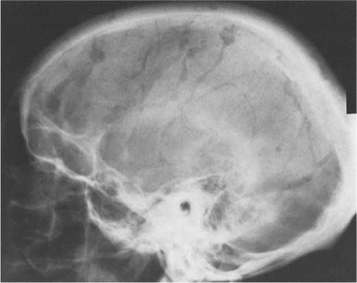 skull fracture calcification