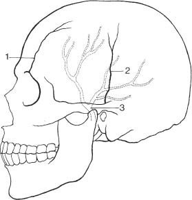 skull fracture calcification